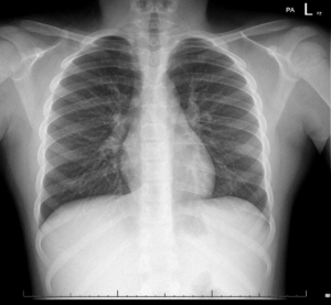 Case – Precordial Catch Syndrome – UNM Pediatrics